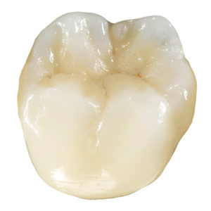 Ceramic Porcelain Fused Zirconia Ceramic Porcelain Fused Zirconia